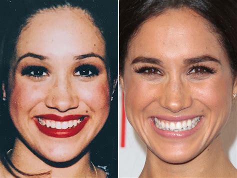 meghan markle nose job|Meghan Markles Nose Is Currently the Most Popular Plastic ...